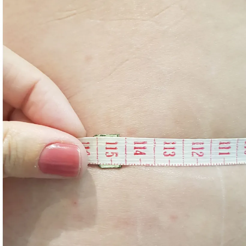 Medição do culote com fita métrica antes das sessões de lipoenzimática