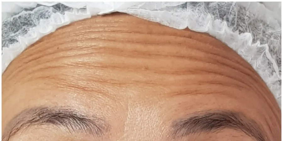 Testa com linhas de expressão marcadas antes da aplicação de toxina botulínica
