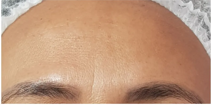 A mesma testa lisa depois da aplicação de toxina botulínica