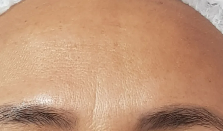 Testa lisa depois da aplicação de toxina botulínica
